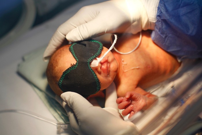 Bác sỹ người Cuba đang che mắt cho một cháu bé sơ sinh ở bệnh viện liên kết Cuba-Venezuela ở Gatire, ngoại ô Caracas, Venezuela.